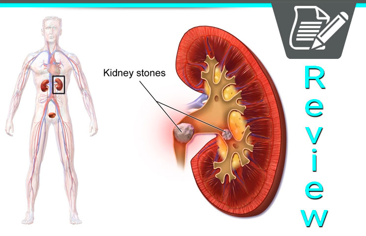 Kidney-Stones