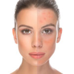 rosacea