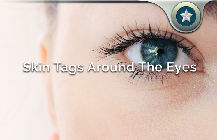 Skin Tags Around The Eyes