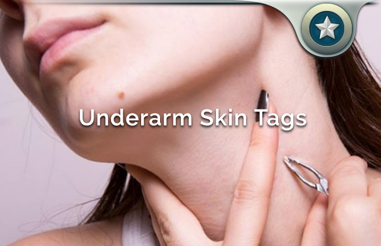 Underarm Skin Tags