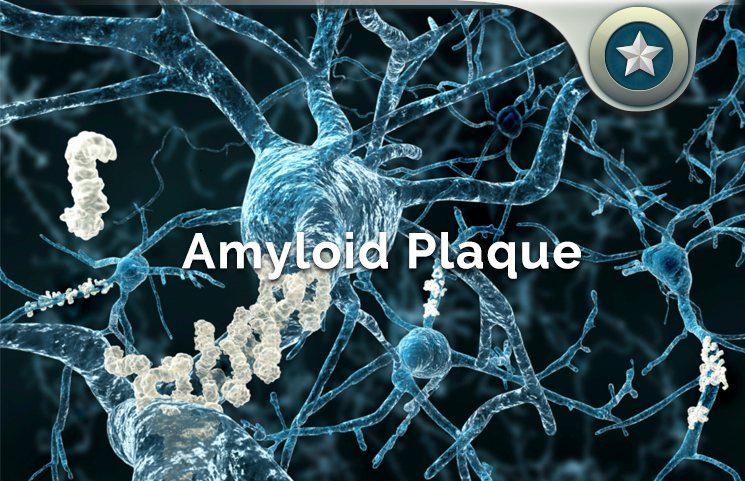 Amyloid Plaque