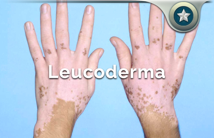 Leucoderma