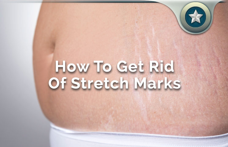 Top 17 Natural Ways On How To Get Rid Of Stretch Marks